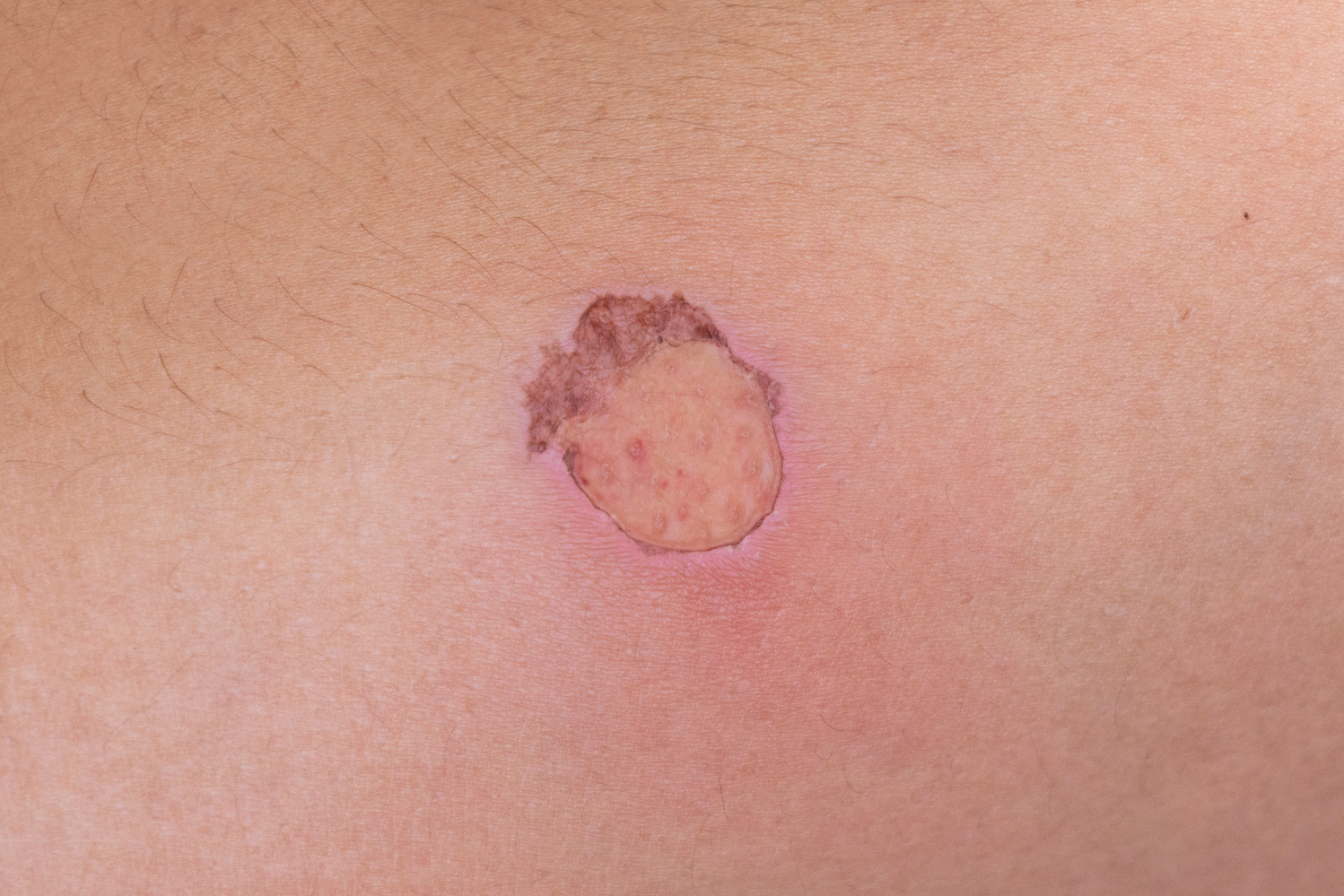 Arm scald,a wound from hot water